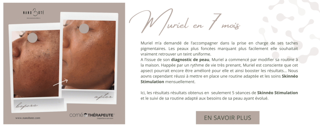 tâches pigmentaires, masque de grosses, tâche visage nano boté clermont ferrand